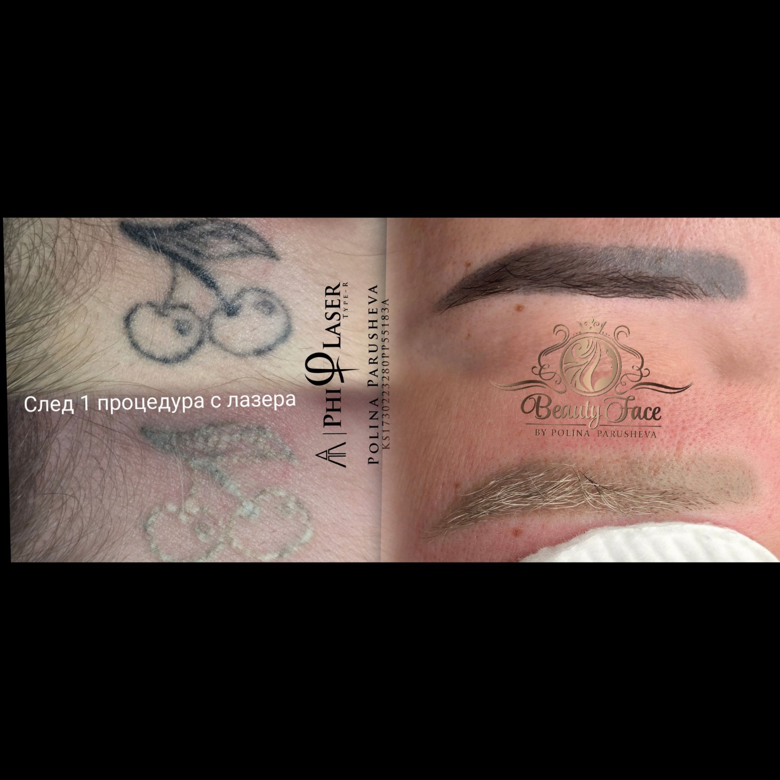 Премахване на Tattoo